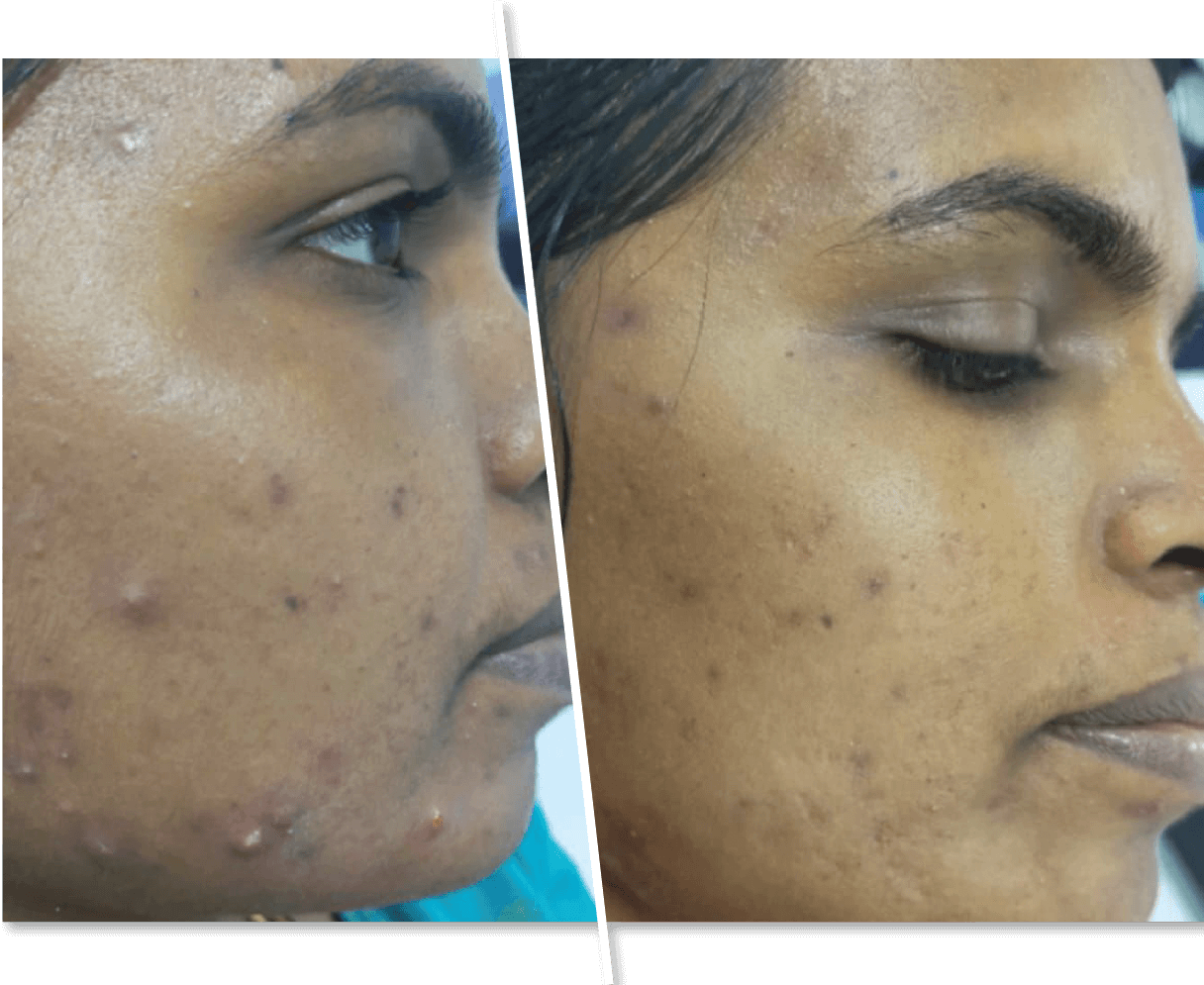 Acne and Pimples Before and After Treatment